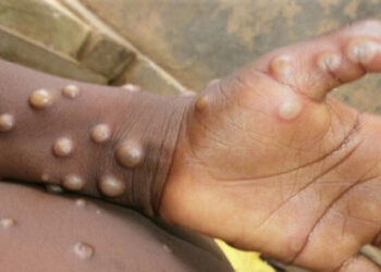 WHO Temukan 100 Kasus Cacar Monyet di 11 Negara