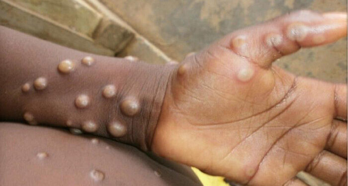 WHO Temukan 100 Kasus Cacar Monyet di 11 Negara