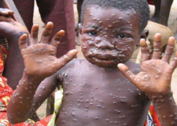 WHO Prediksi Penyakit Cacar Monyet Bakal Menyebar Cepat ke Seluruh Dunia