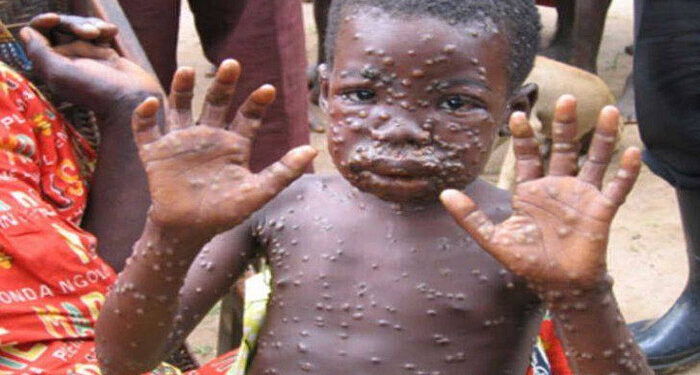 WHO Prediksi Penyakit Cacar Monyet Bakal Menyebar Cepat ke Seluruh Dunia