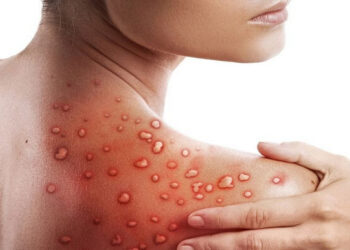 Para Ahli Global Teliti Kasus Kematian Langka Akibat Cacar Monyet