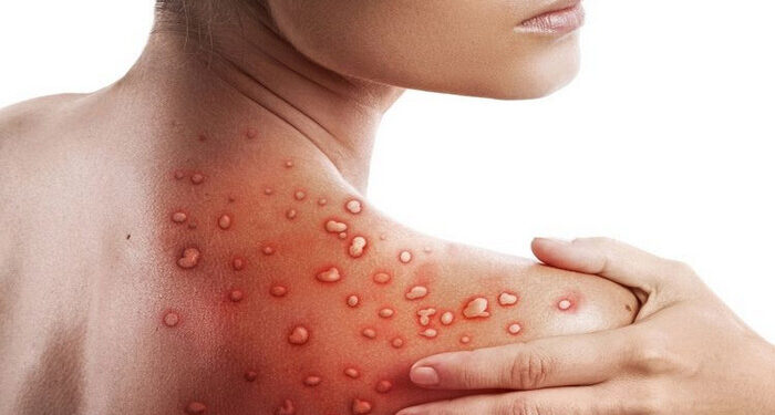 Para Ahli Global Teliti Kasus Kematian Langka Akibat Cacar Monyet