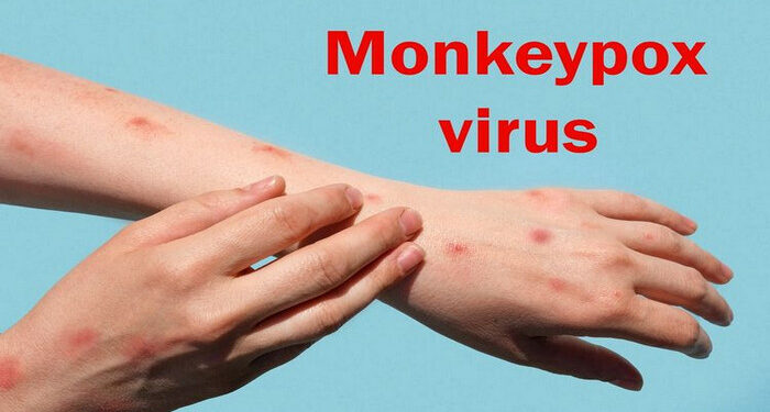 Waspada! Indonesia Temukan Kasus Cacar Monyet Pertama