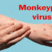 Waspada! Indonesia Temukan Kasus Cacar Monyet Pertama