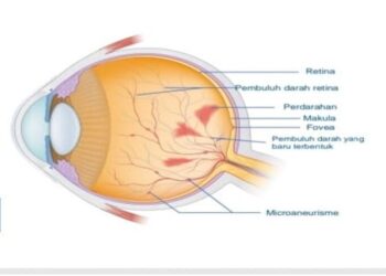 Mewaspadai Pasien Diabetik Makular yang Berisiko Kebutaan