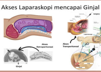 Apakah yang Anda ketahui tentang Penyakit Ginjal Kronik?