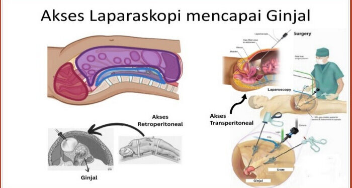 Apakah yang Anda ketahui tentang Penyakit Ginjal Kronik?