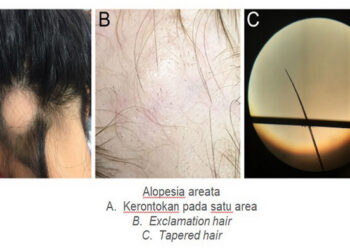 Kapankah Perlu Transplantasi Rambut?