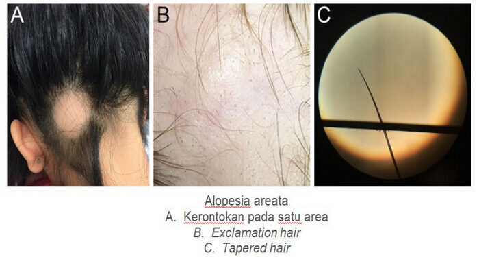 Kapankah Perlu Transplantasi Rambut?