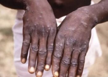 Dua Pasien Cacar Monyet di Tangerang Selatan Telah Diisolasi