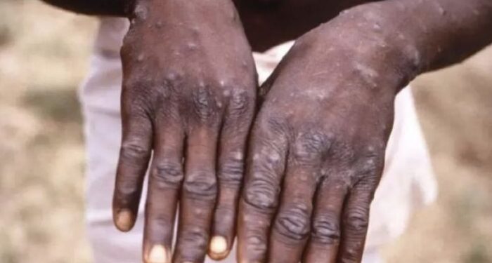 Dua Pasien Cacar Monyet di Tangerang Selatan Telah Diisolasi